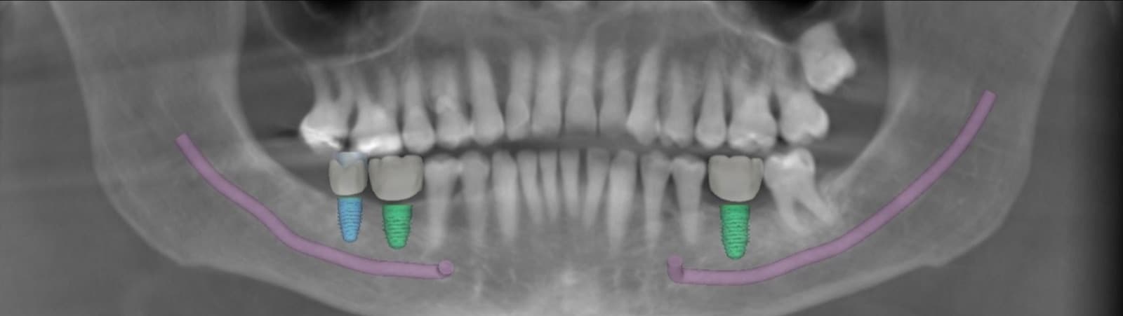 Panoramic dental radiograph showing proposed mandibular implants and traced inferior alveolar nerves.