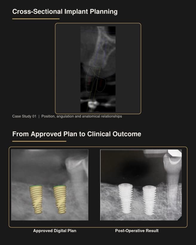 Case study showing cross-sectional implant planning and a comparison of the approved digital plan with the postoperative radiographic result.