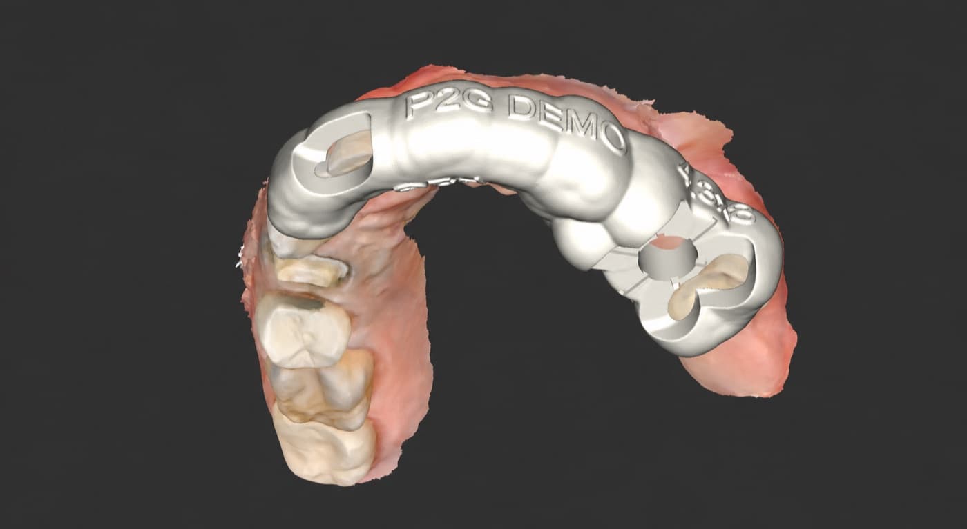 Digital rendering of a case-specific surgical guide seated over an intraoral scan.