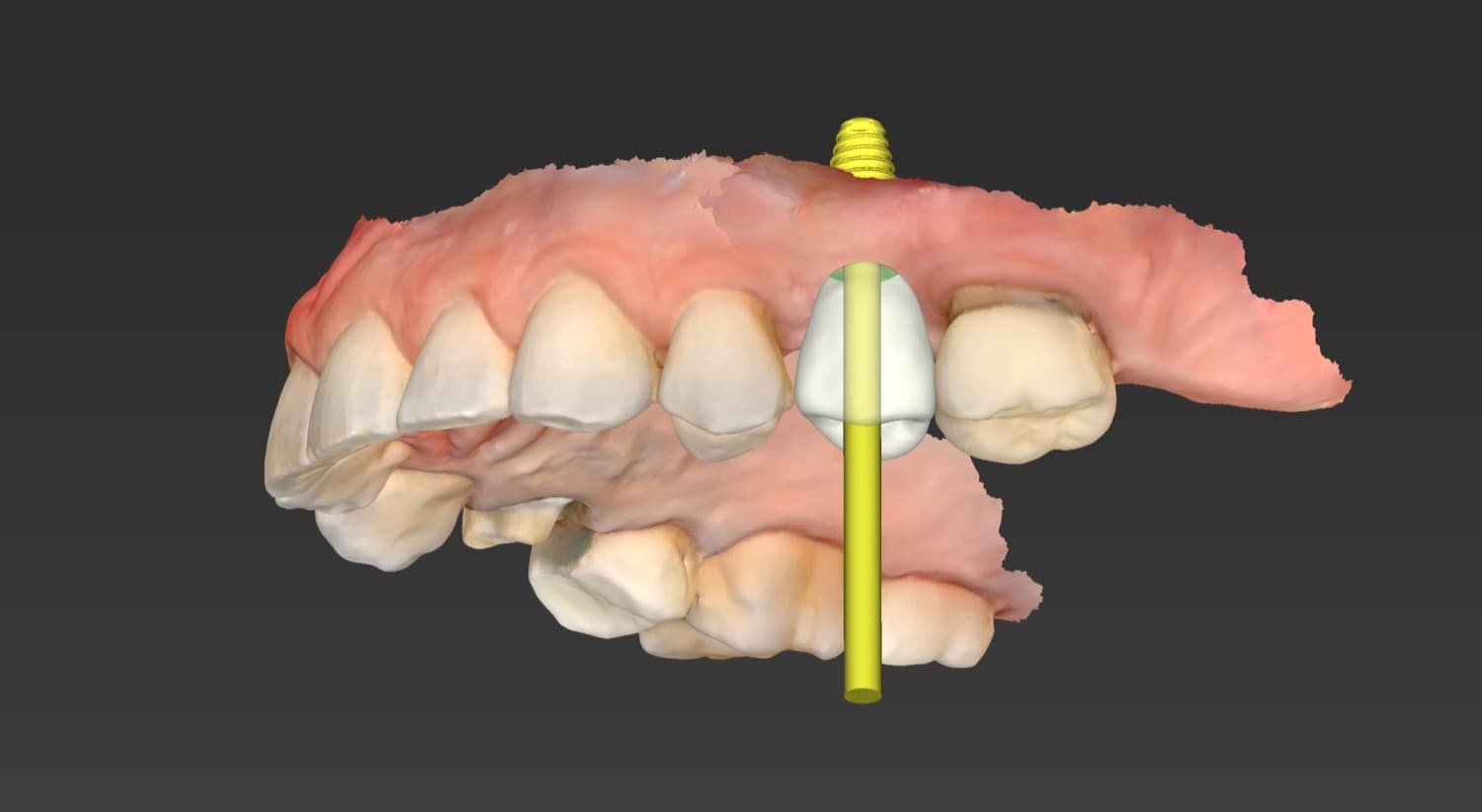 Digital implant plan showing a proposed restoration and guided implant trajectory.